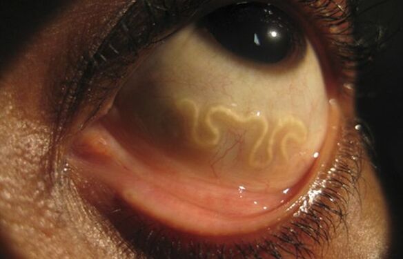 O verme loa loa vive no ollo humano e causa cegueira